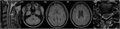 Drug-related immune-mediated myelopathies